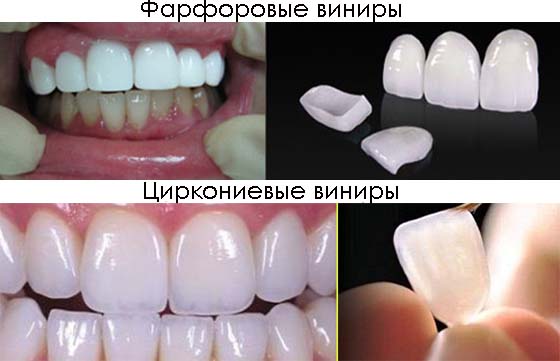виниры